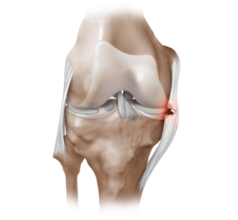 частичный надрыв боковой связки коленного сустава